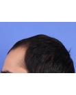 Before Hair Transplant&nbsp;Front